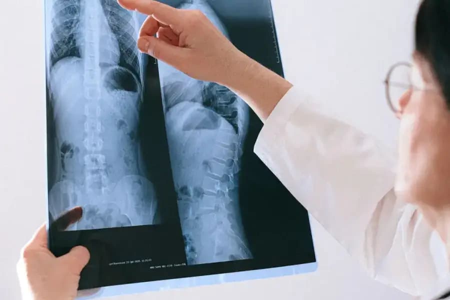 Cervical Spondylosis Physiotherapy Treatment Bangalore Cervical spondylosis physiotherapy Bangalore — anatomical illustration of cervical spine wear-and-tear, disc degeneration and neck nerve compression treated at Pro Physiotherapy JP Nagar 8th Phase by Dr J Mazumdar PT