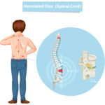 herniated-disc-physiotherapy-treatment