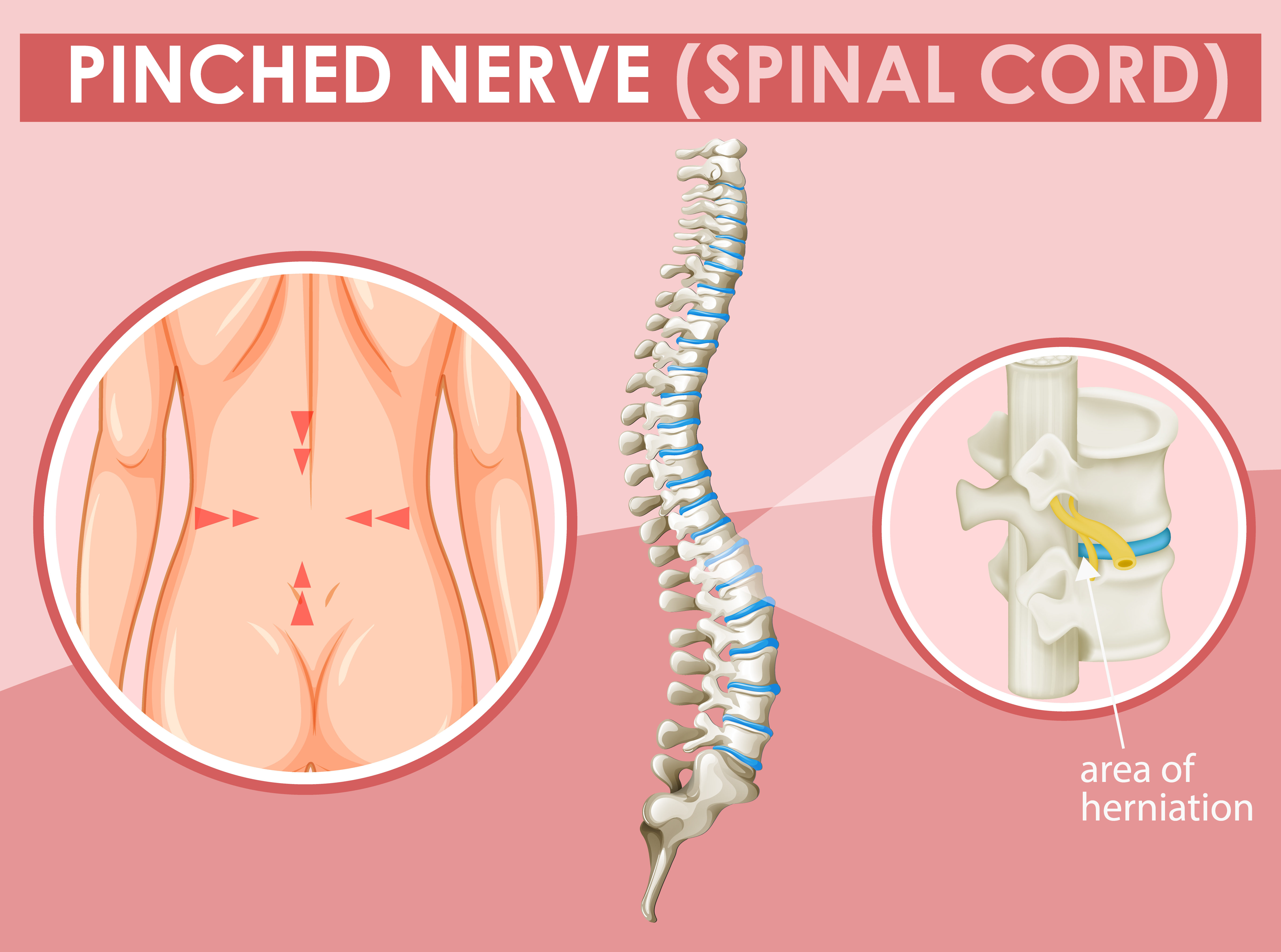Physiotherapy-for-sciatica-pinched-nerve