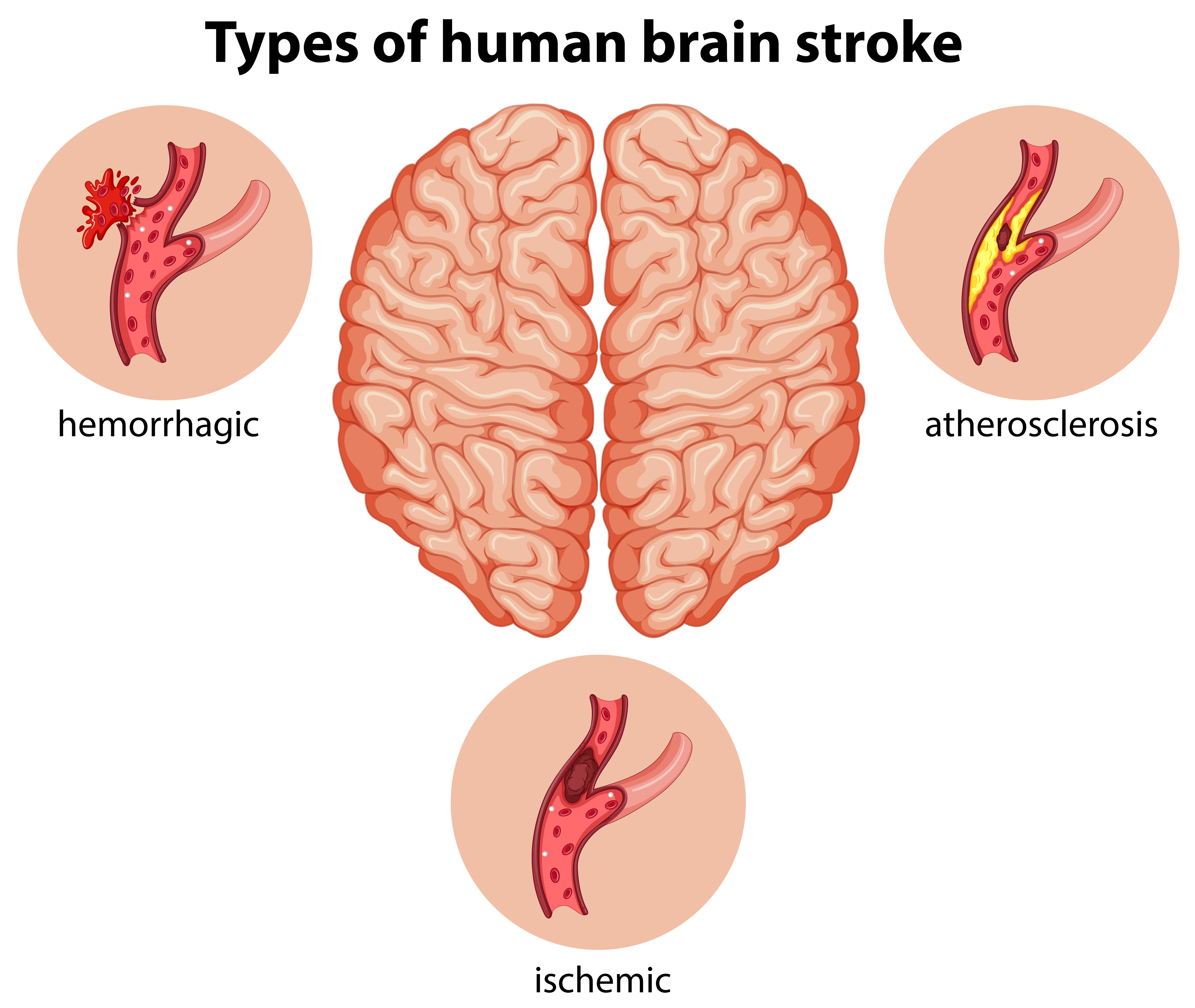 types-of-brain-stroke
