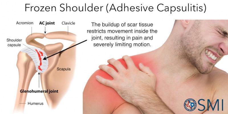 Symptoms of Frozen﻿ shoulder- patient is suffering from